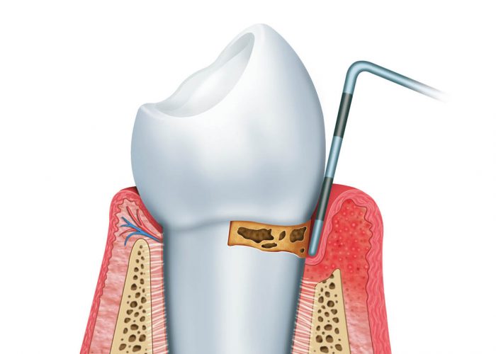 Periodoncia