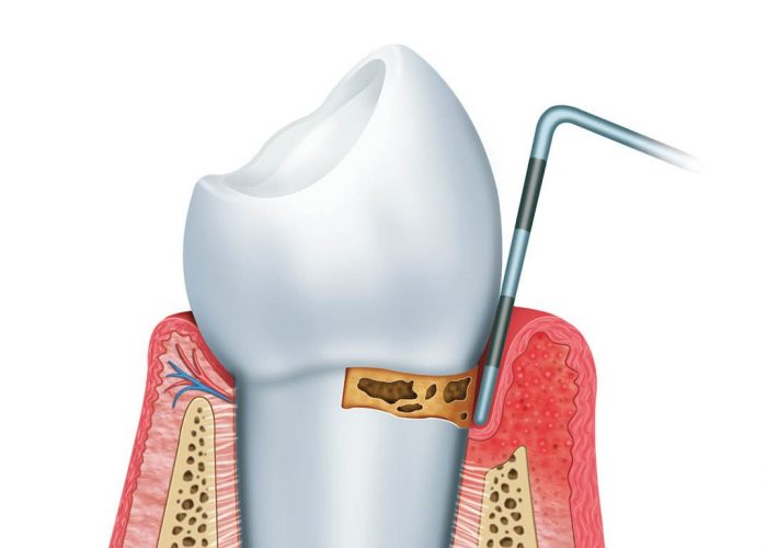 Periodòncia
