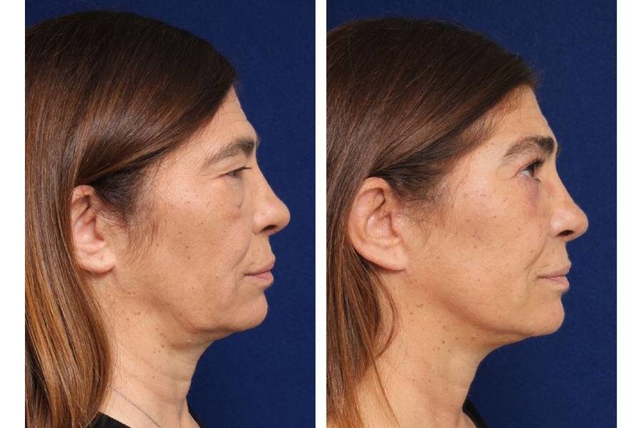 Minilifting Facial con Blefaroplastia Superior e Inferior - Carolina  Plásticos Faciales