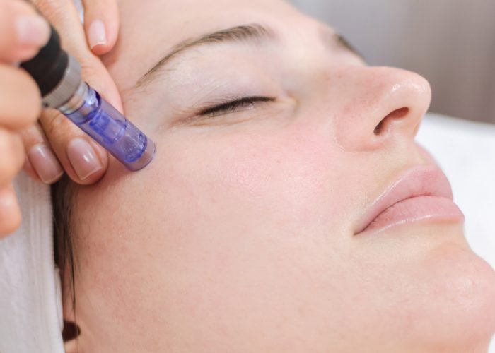 Microneedling