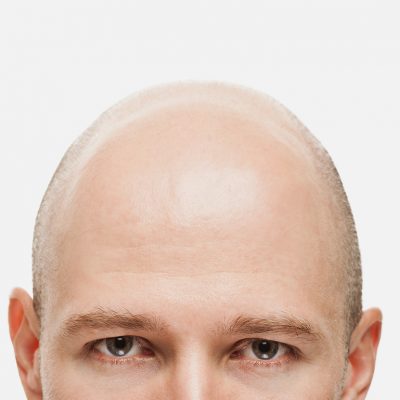 Alopecia