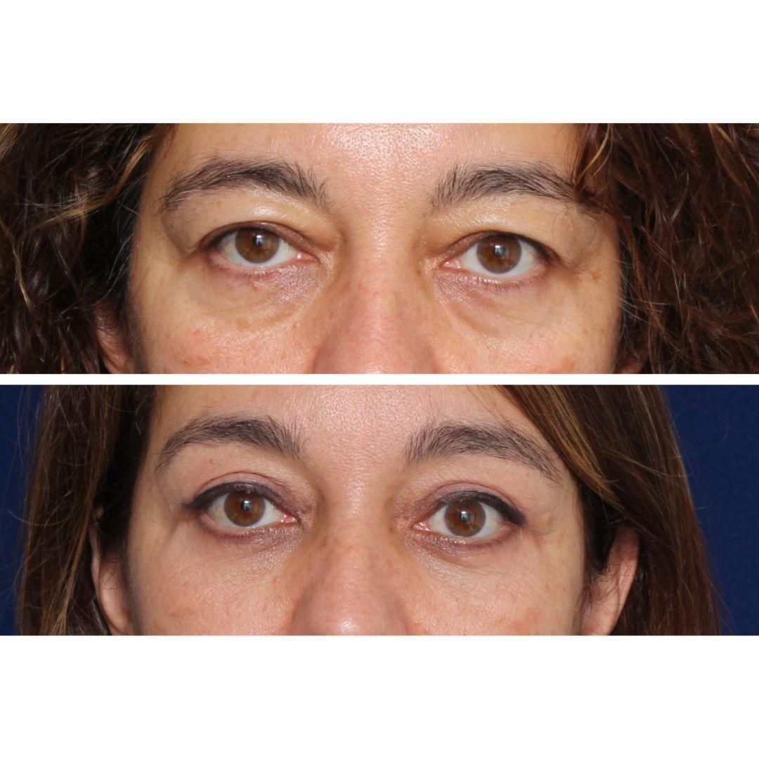 Blefaroplastia