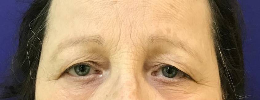 Brow lift